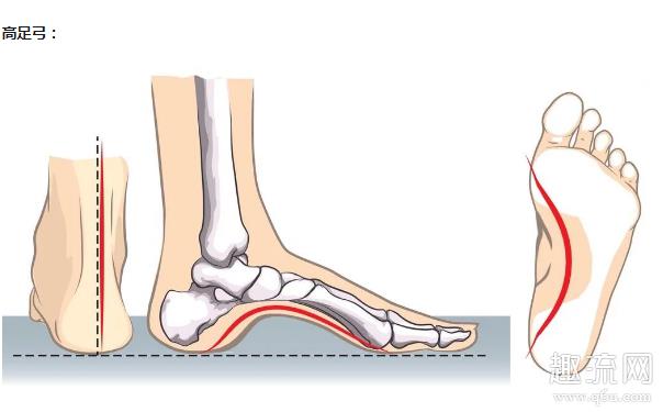 高足弓适合跑马拉松吗 高足弓适合什么跑鞋