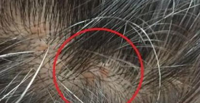 头皮长痘痘很痒怎么办