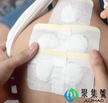 三伏贴痒可以抹皮炎平吗(三伏贴怎么贴,贴哪里)