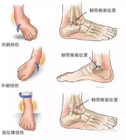 脚踝扭伤怎么办 如何预防脚踝扭伤