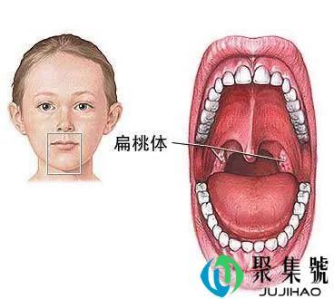 扁桃体是什么，扁桃体发炎吃什么药好得快些