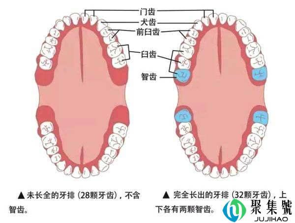 冠周炎拔牙多少钱，良心医生不建议拔智齿