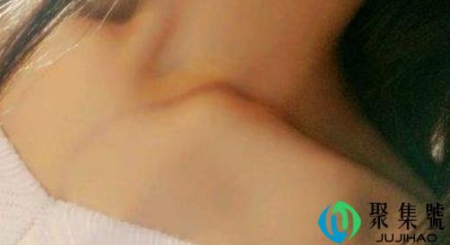 一字锁骨和v字锁骨区别