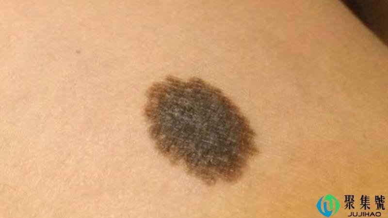 黑点和痣的区别