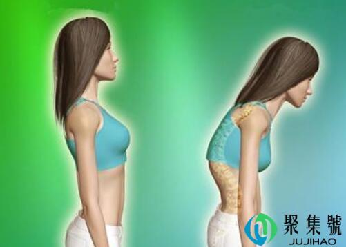 驼背怎么办