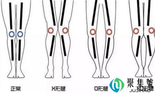 如何把O型腿变成直腿