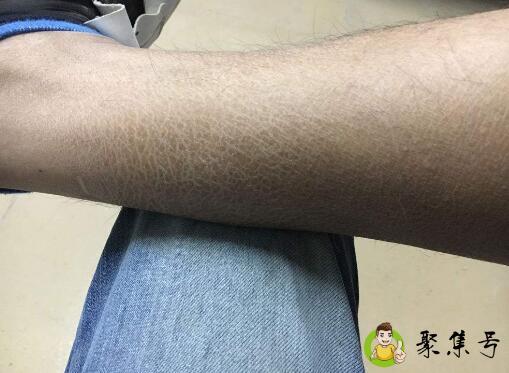 去蛇皮腿的小妙招