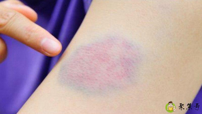 淤青和淤紫有什么区别