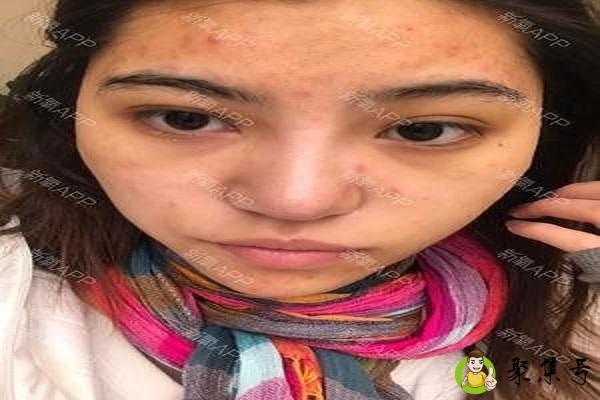 角栓和油脂粒区别