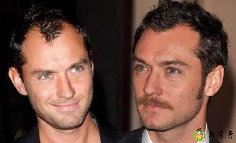 正常发际线高度几厘米