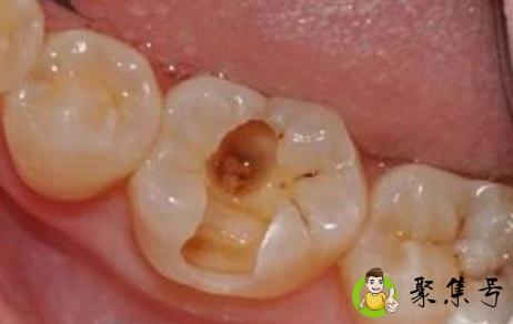 补牙材料150和300区别