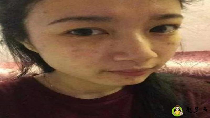 麻子脸是什么意思