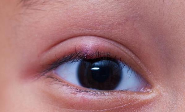 眼睛经常长麦粒肿是怎么回事？